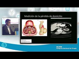 Uso de Neumoperitoneo Progresivo para el manejo de Hernias Incisionales Complejas