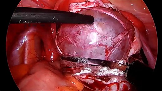 Dermoid Cyst of Ovary - Laparoscopic Removal Without Spillage