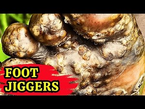 shocking🫨 most jiggered foot 🦵🏻- treatment #1 - long video @hasmedicera ​