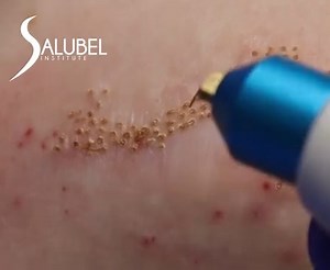 USOS DEL PLASMA PEN✨ Conoce más acerca del Plasma Pen😉💖 ✨¿Qué es? ✨¿Cómo funciona? ✨Sus principales tratamientos ✨Beneficios del Plasma Pen sobre otras técnicas Si te interesa capacitarte en esta increíble y versátil técnica envíanos mensajito🙌🏻 ¡contamos con capacitaciones disponibles al mejor precio!😊 #fibroblast #plasmapen #woman #antiaging #brotesdeacné #beautymonster #maglev | Salubel