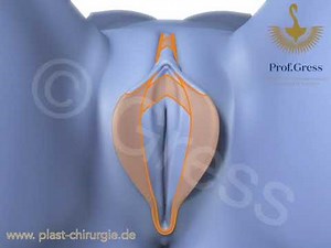 Composite Reduction Labiaplasty: Labia + Clitoral Hood Reduction, correction of clitoral protrusion