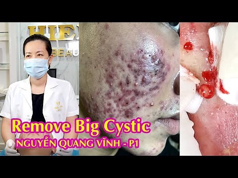 Remove Big Cystic | No. 1 Effective Acne Treatment Hien Van Spa | Nguyen Quang Vinh | Part 1 | 525