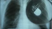 X-Ray Image of Chest with Artificial Cardiac Pacemaker Under...