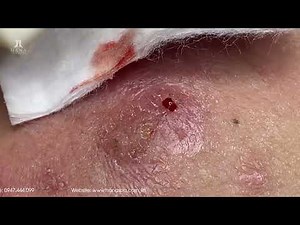 Big Cystic Acne Blackheads Extraction Blackheads & Milia, Whiteheads Removal Pimple Popping