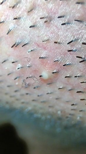 Mesmerizing Tweezers Blackhead Extraction ASMR Video for Relaxation