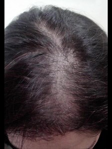 Too late is too late. Especially when it comes to losing your hair....