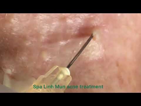 Acne hidden under skin of the lady | Spa Linh Mun Acne Treatment