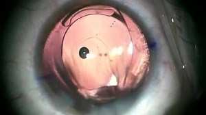 PCCC for Fibrotic Plaque and Residual Silicone Oil Removal (Part 2) - Eyetube