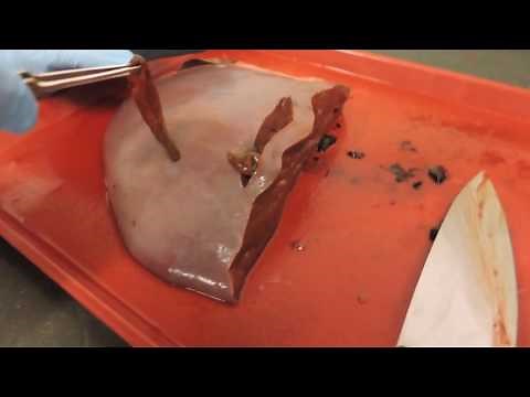 Giant liver flukes from a deer liver