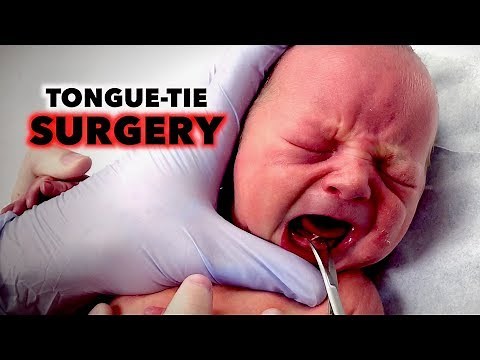 TONGUE-TIE SURGERY on NEWBORN (Frenotomy) | Dr. Paul