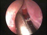 Maxillary Sinus Cholesterol Cyst - Endoscopic Removal • Video • MEDtube.net