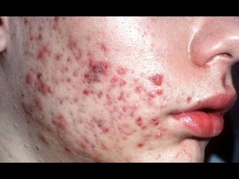 Acne Vulgaris! Acne! Acne Removal, Acne Treatment and Acne Problems