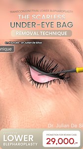 💡 Transconjunctival Lower Blepharoplasty: The Scarless Under-Eye Bag Removal! 👁✨ ✅ No visible external scars! ✅ Removes under-eye bags for a refreshed look ✅ Faster healing & minimal downtime ✅ Preserves natural eyelid shape 📩 Book your consultation and lift your look today ✨ 🏪 INTERPLAST Clinic 📍 Just 300m from BTS Ploen Chit, Bangkok 📞 Tel: 02-056-2108 | www.interplastclinic.com #lowerblepharoplasty #eyelidsurgery #blepharoplasty #INTERPLAST #interplastclinic #bangkok | Interplast Clinic