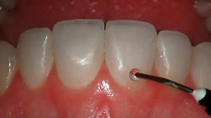 Smile design with dental venners 朗 | Dentistry blog | Facebook