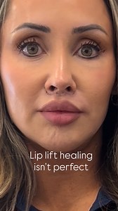 13K views · 20 reactions | Early lip lift healing isn’t perfect. Incisions are visible. Swelling can be intense. Confidence wobbles. That doesn’t mean something went wrong. It means you’re in the process. Most people only see the before and after. The middle matters. #liplift #surgicalliplift | Maddiespageforbeauty | Facebook
