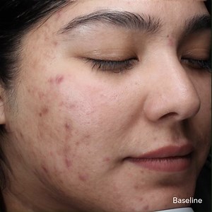 6.7K views · 20 shares | Retinol + Acne Complex—transform your skin...