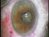 PFC Flotation of a Dropped Mature Cataract - Eyetube