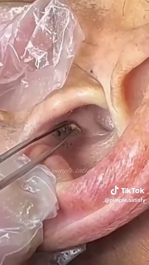 Giant blackhead removal #satisfying #explore #foryou #fyp #blackheads #pimple #relaxing