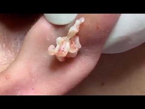 Massive Earlobe CYST (Epidermoid Cyst Removal)