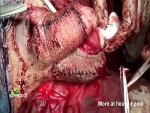 Skin Restoration For Penile Paraffinoma