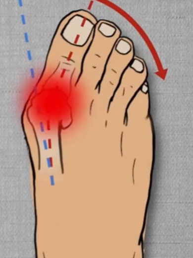 Hallux Valgus und das Fußgewölbe: Die Verbindung verstehen
