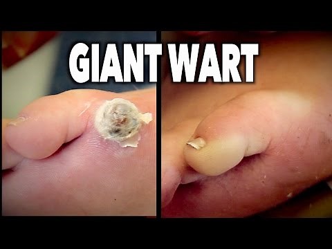 GIANT WART (Before & After) + FREEZING A FRESH WART