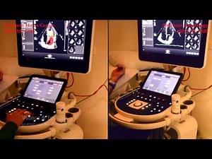 2D Echocardiogram
