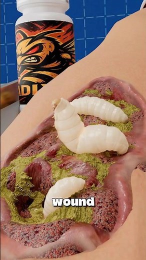 Doctors Use Live Maggots To Heal Wounds 🪱💊