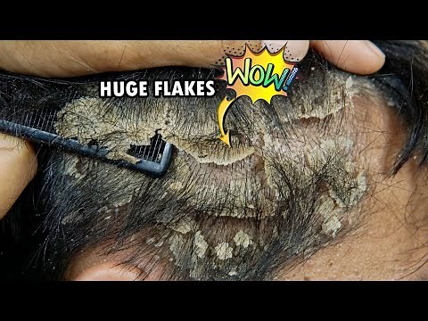 Psoriasis Scalp Scratching Huge Flakes Satisfying #735