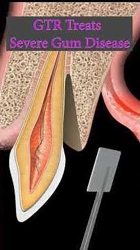 #GTR#Guided-Tissue-Regeneration#gum-surgery