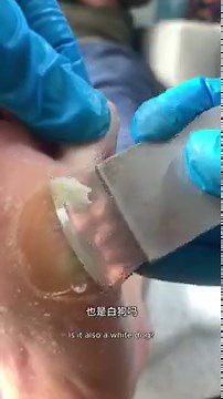 Callus Formation Explained: Why They Reappear on Your Feet