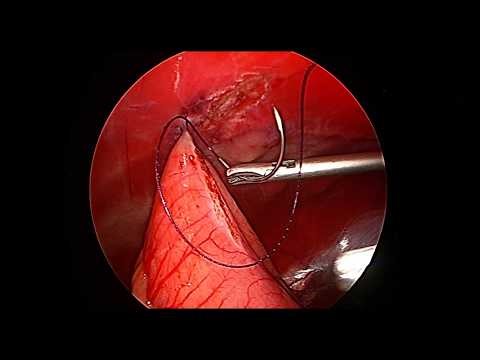 Total Laparoscopic Gastropexy in a dog using V-Loc Suture