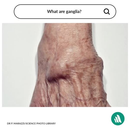 2.9K views | Ganglia are cystic swellings occurring usually on the hands, especially on the dorsal aspect of the wrists. Aspiration or excision is indicated for symptomatic ganglia. Refresh your knowledge: https://mrkmnls.co/4doZoOL | Merck Manual Professional | Facebook