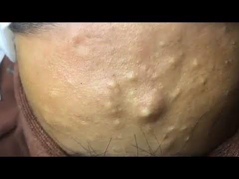 How to Remove Blackheads And Whiteheads On Face Easy ✦ Acne Treatment ✦