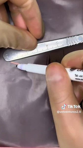 Rotation Flap Surgery Explained