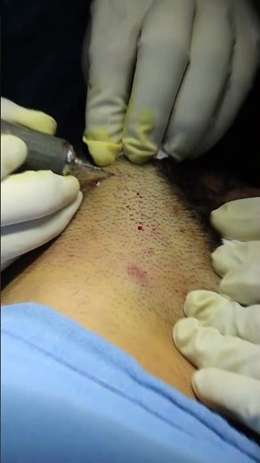 Hair Transplant Procedure by Dr. Adarsh Tripathi