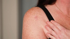 Immer mehr Menschen betroffen: Weißer Hautkrebs: Warum regelmäßige Vorsorge so wichtig ist