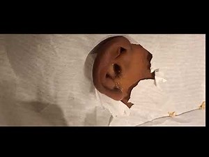 Hard impacted ear wax removal