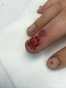 Nailbed Injuries, Part I