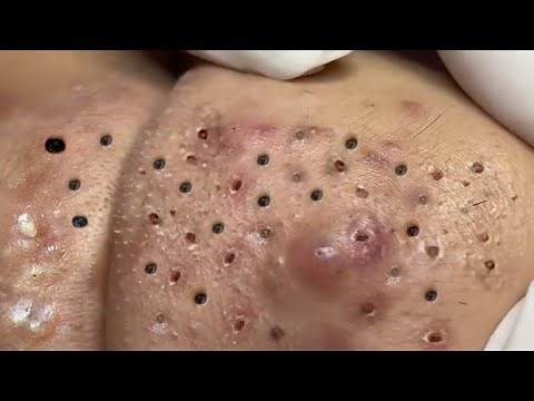 Remove Blackheads and Pustules on the chin