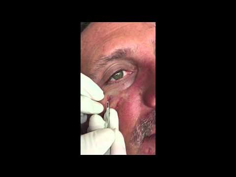 Removing a mole and extracting milia. For medical education- NSFE.