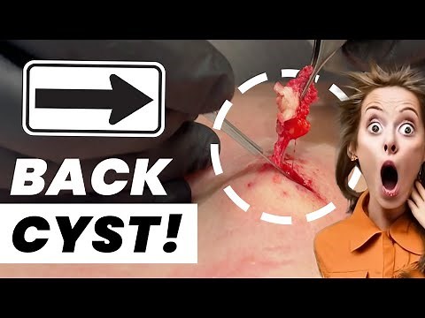 BACK CYST!