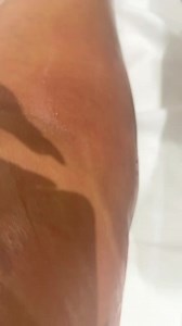 Vacuum  Sculpting Vacuum therapy is a non-invasive treatment to combat severe cellulite. It is carried out using suction devices that drain the adipose tissue and move the fat towards the lymphatic system. Vacuum therapy also helps to eliminate fat, it has an exfoliating effect, provides elasticity to the skin and relaxes the muscles. | EndermaSpa Beauty Center | Facebook