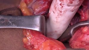 Distal Biceps Tendon Reconstruction with Achilles Allograft