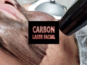 Carbon Laser Facial - Video#4- Track all our content of Carbon Peels with #carbonvelvetfacial ⚒ Reduces fine lines and wrinkles 🤳 Tightens dilated pores 👀 Reduces acne, scars and post acne discoloration 🌈 Removes dead skin cells from the superficial epidermal layer 📈 Stimulates collagen growth 🔬Improves skin texture ♨Clears pores to help reduce blackheads and whiteheads Performed by licensed Esthetician and/or certified Laser Technician, with a combined 20 years experience. With LED Light T