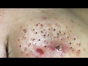Remove Blackheads on the Edge At HT Spa