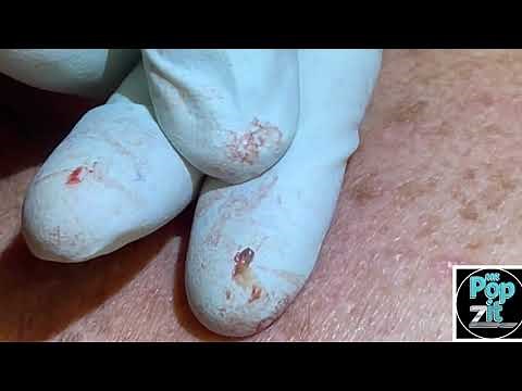 Back Blackhead extractions. Multiple dry clogged pores extracted on back. Big squeeze. MrPopZit.