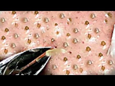 Big Whiteheads on the Nose Create Huge Craters