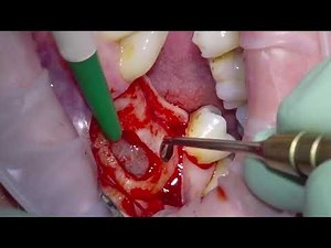 Dental Implant Placement and Simultaneous Sinus Graft