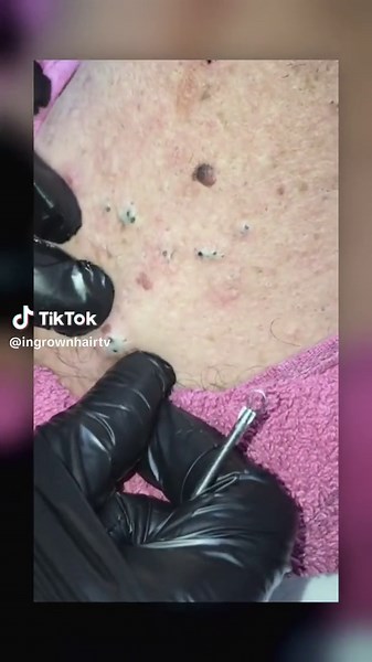 huge deep blackheads removal #pimple #blackhead